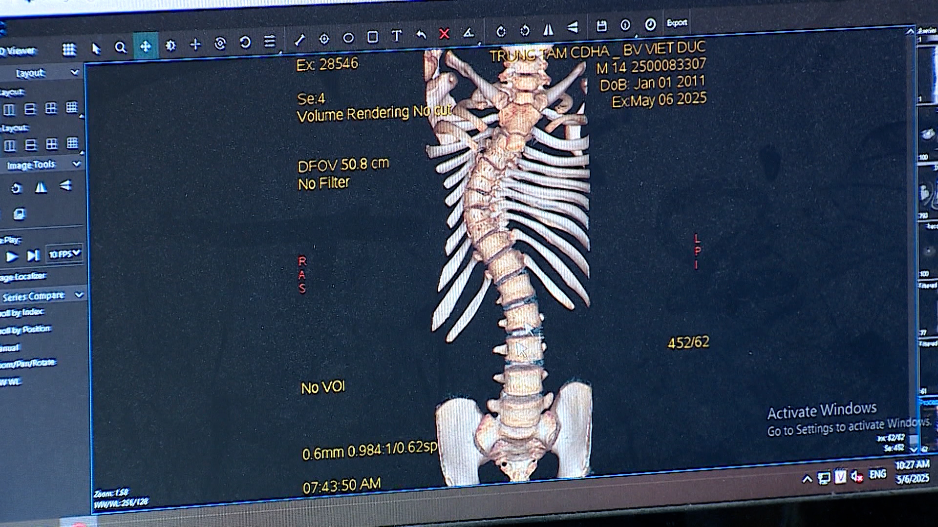 Giải pháp toàn diện trong phẫu thuật cột sống | Sức khỏe cộng đồng | 05/07/2025